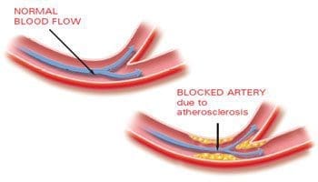 Blocked Arteries Diagram - El Paso Chiropractor