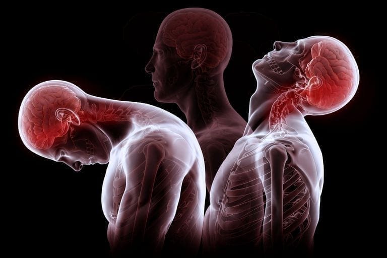 Studies Demonstrate Effectiveness of Chiropractic for Whiplash