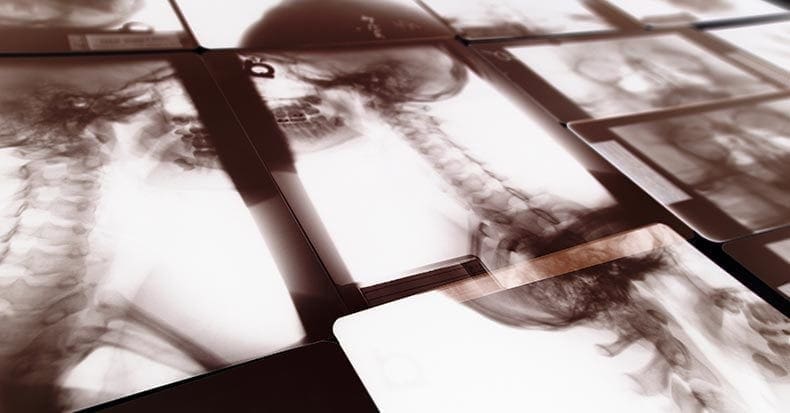 Whiplash Injuries: El Paso Neck Chiropractor