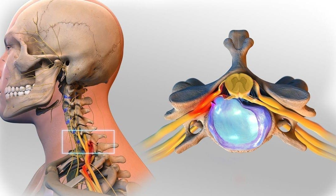 Progression and Diagnosis of Herniated Discs | Scientific Specialist
