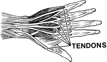 tendinosis