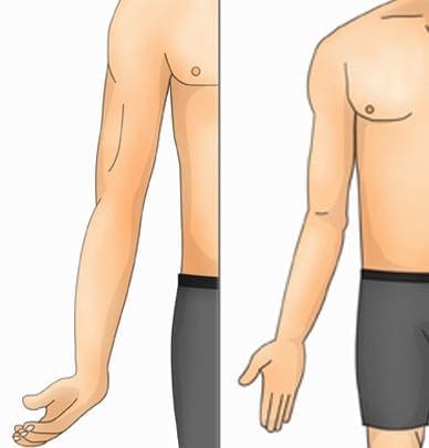 Erb's Palsy Image | El Paso, TX Chiropractor