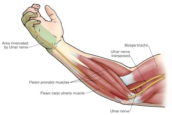 Ulnar Nerve Entrapment | El Paso, TX Chiropractor