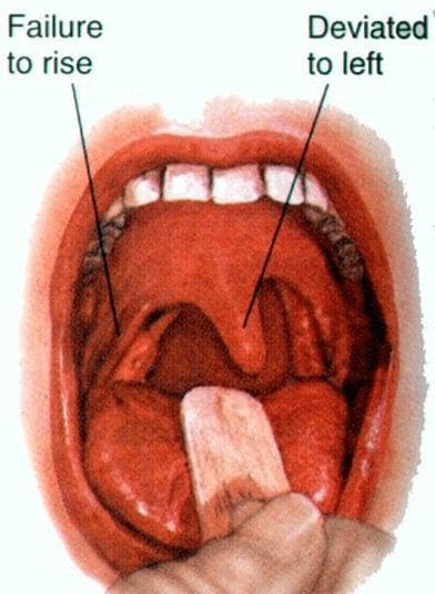 Testing Cranial Nerve IX and X | El Paso, TX Chiropractor