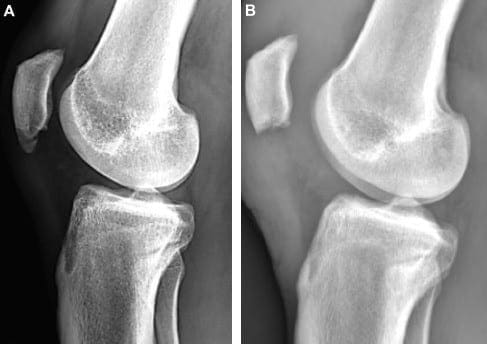 What Is Sinding-Larsen-Johansson Syndrome?