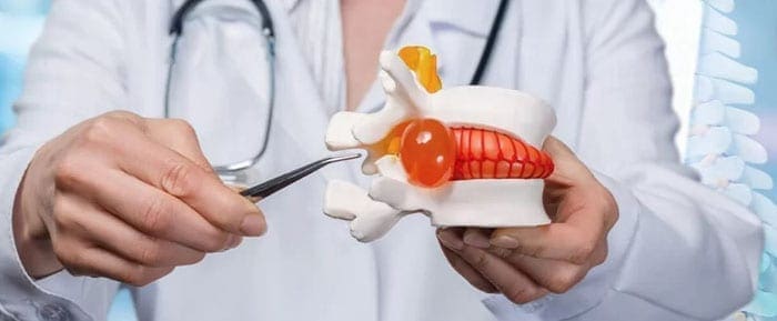 Regenerative Options for Disc Herniations Insights