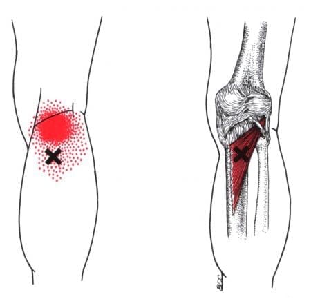 Having Unquestionable Knee Pain? Could Be Trigger Points