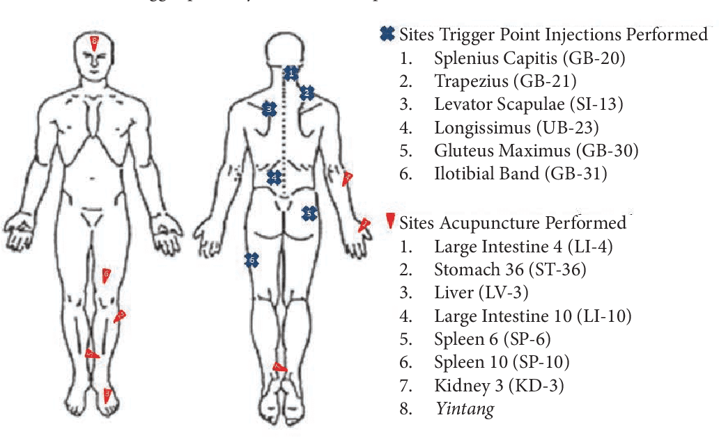 The Benefits of Acupuncture for Fibromyalgia