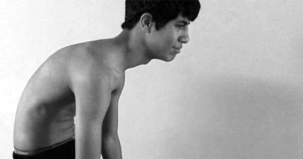 Chiropractic Fixes Hunched Back Teen