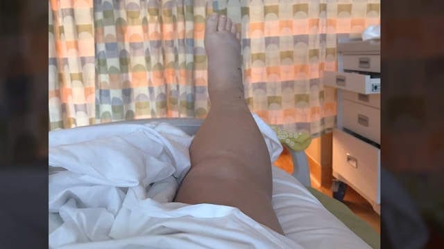 What It Really Feels Like to Get Bit by a Rattlesnake