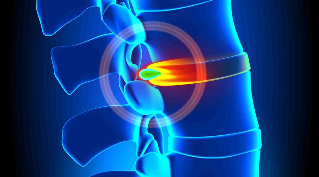 Disc and Ligament Injuries: Documenting the Cause