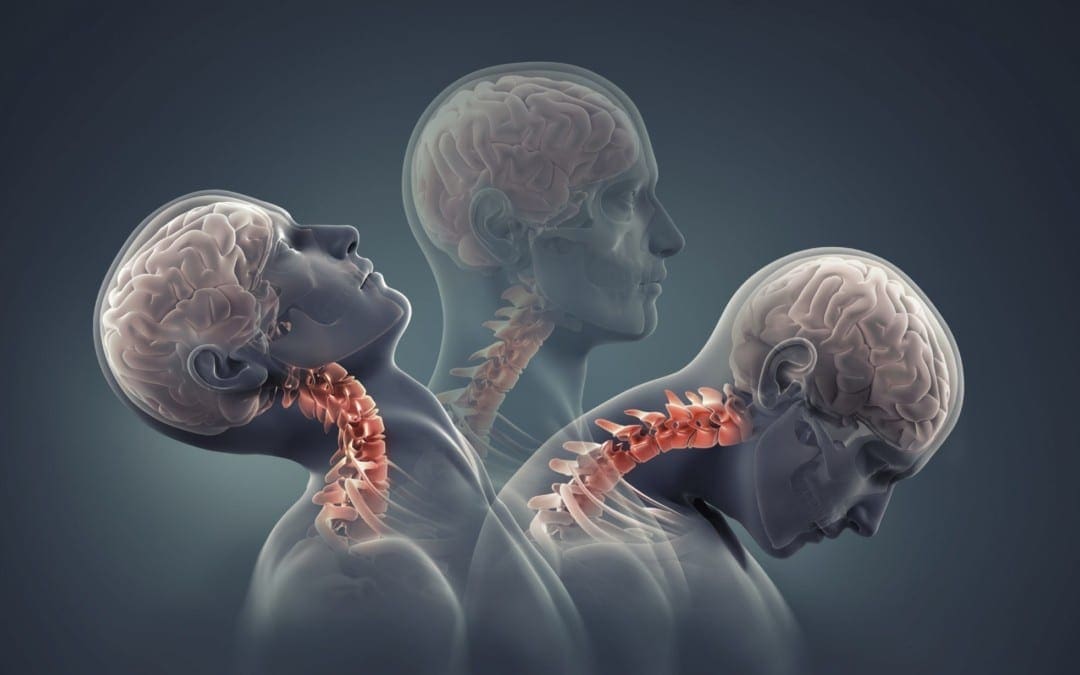 Whiplash Caused by Acceleration and Deceleration