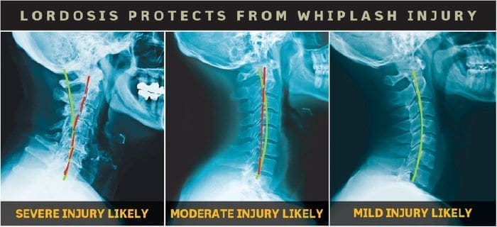 whiplash rehabilitation el paso, tx.