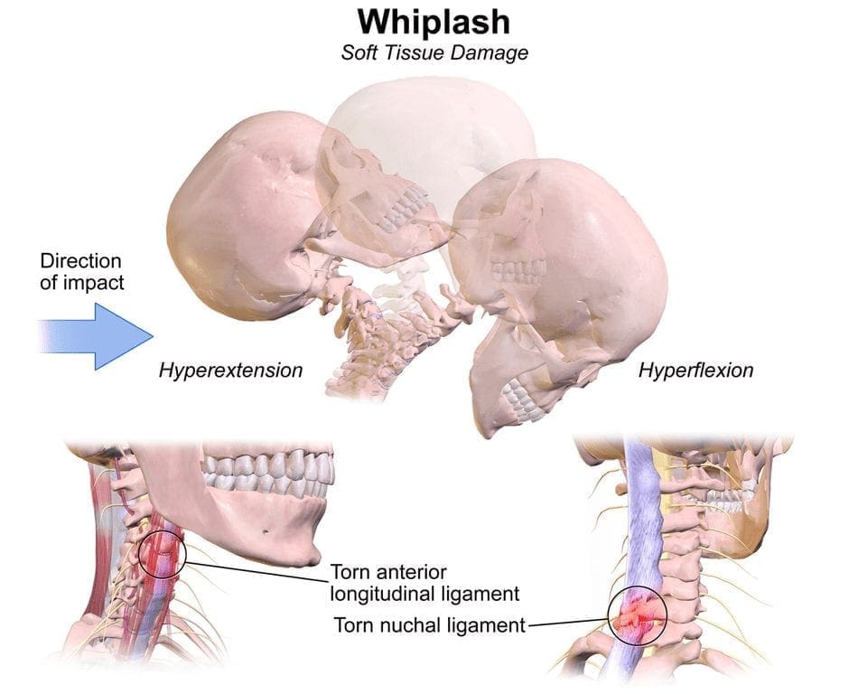 Whiplash diagram el paso tx