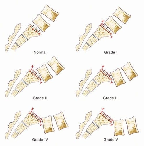 Image demonstrating the different grades of spondylolisthesis.