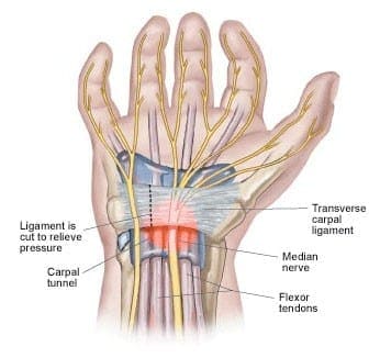 Carpal Tunnel Syndrome | El Paso, TX Chiropractor