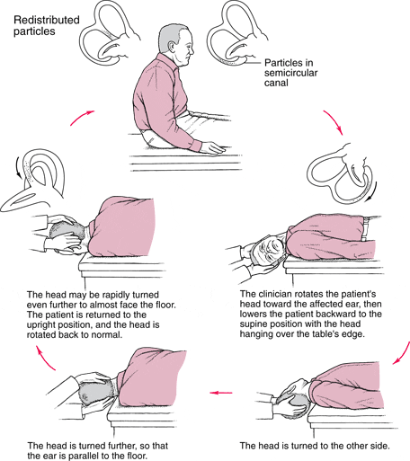 Epley Maneuver Diagram | El Paso, TX Chiropractor