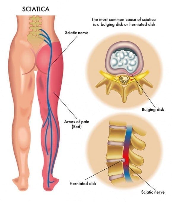 Sciatic Nerve Pain Diagram | El Paso, TX Chiropractor