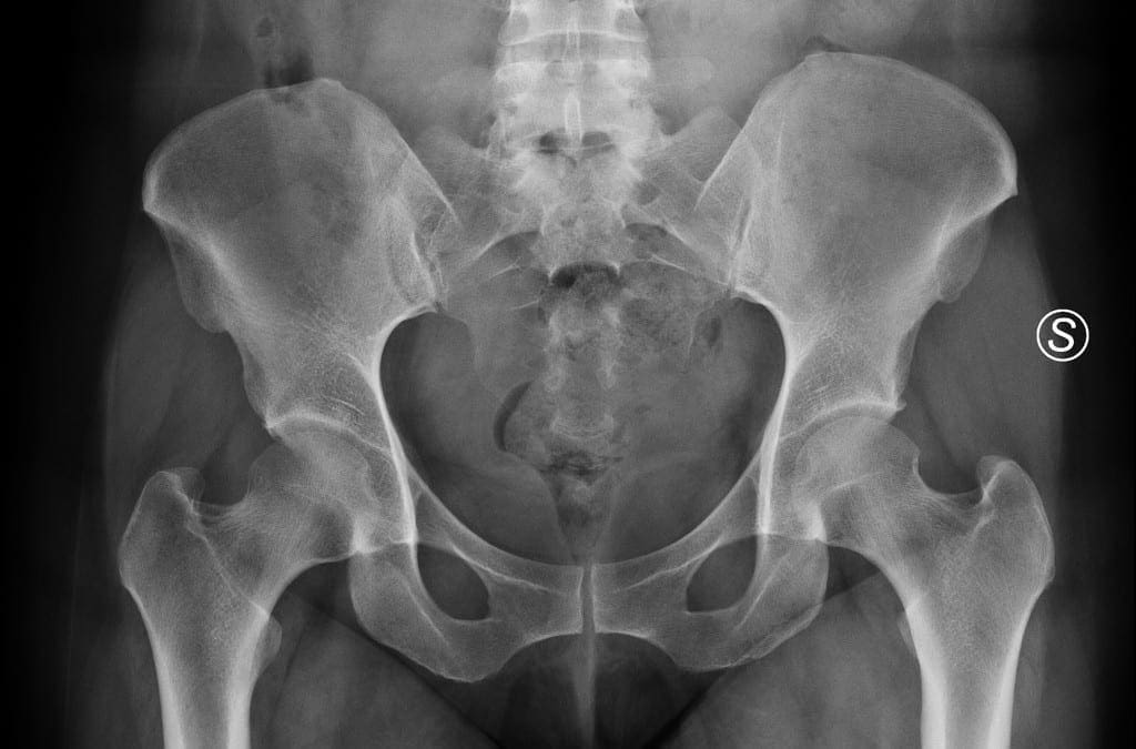 Osteitis Pubis Treatment