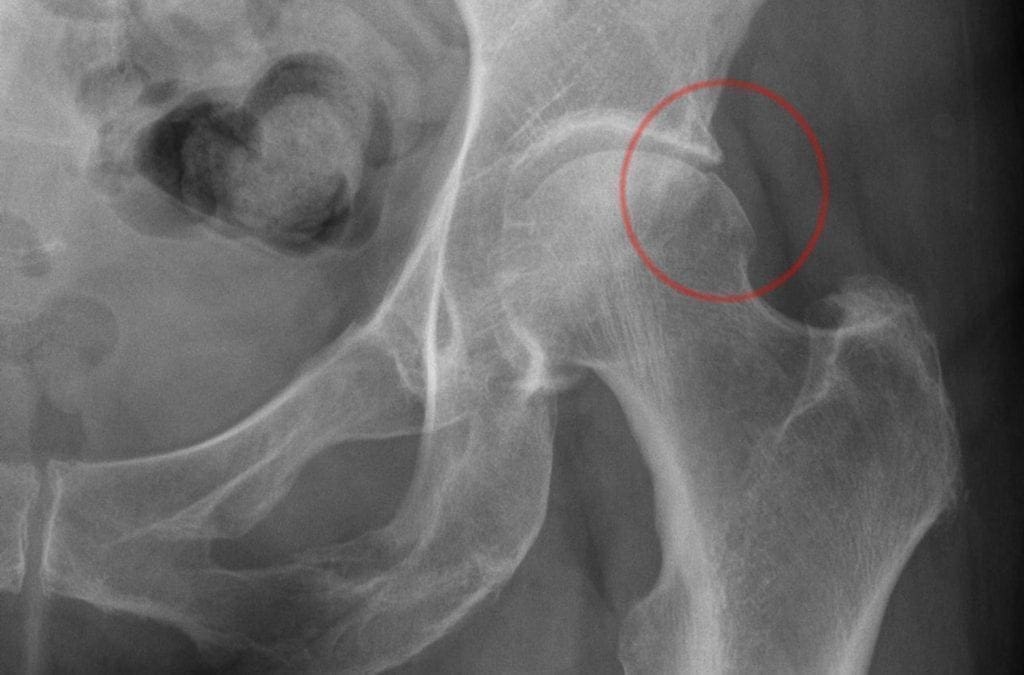 Femoroacetabular Impingement