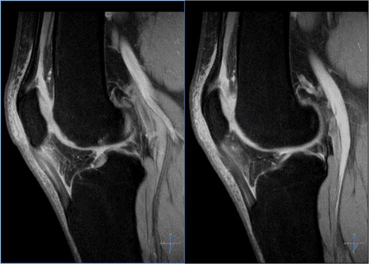 What is Patellar Tendinitis?