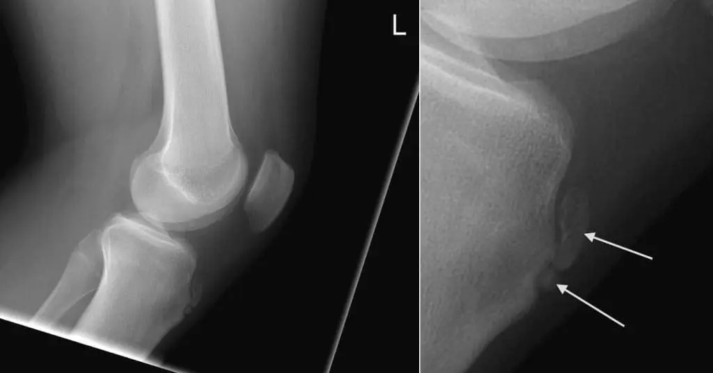 What is Osgood-Schlatter Disease?