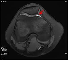 What is Knee Plica Syndrome?