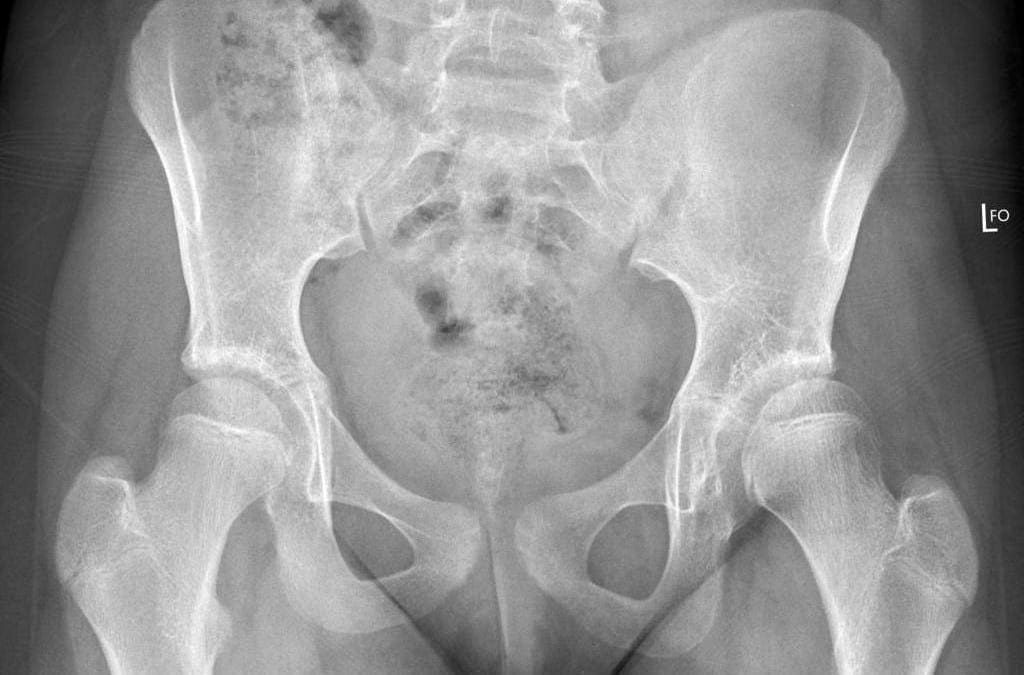 Developmental Dysplasia of the Hip