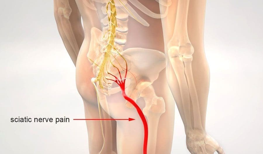 Overcoming Sciatic Nerve Pain: A Personal Approach