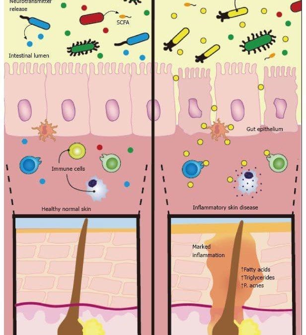 A Healthy GI Can Relieve Atopic Dermatitis