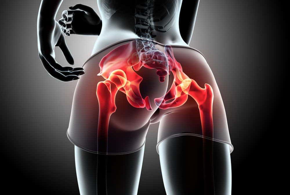 Piriformis Syndrome May Cause More Than Hip Pain