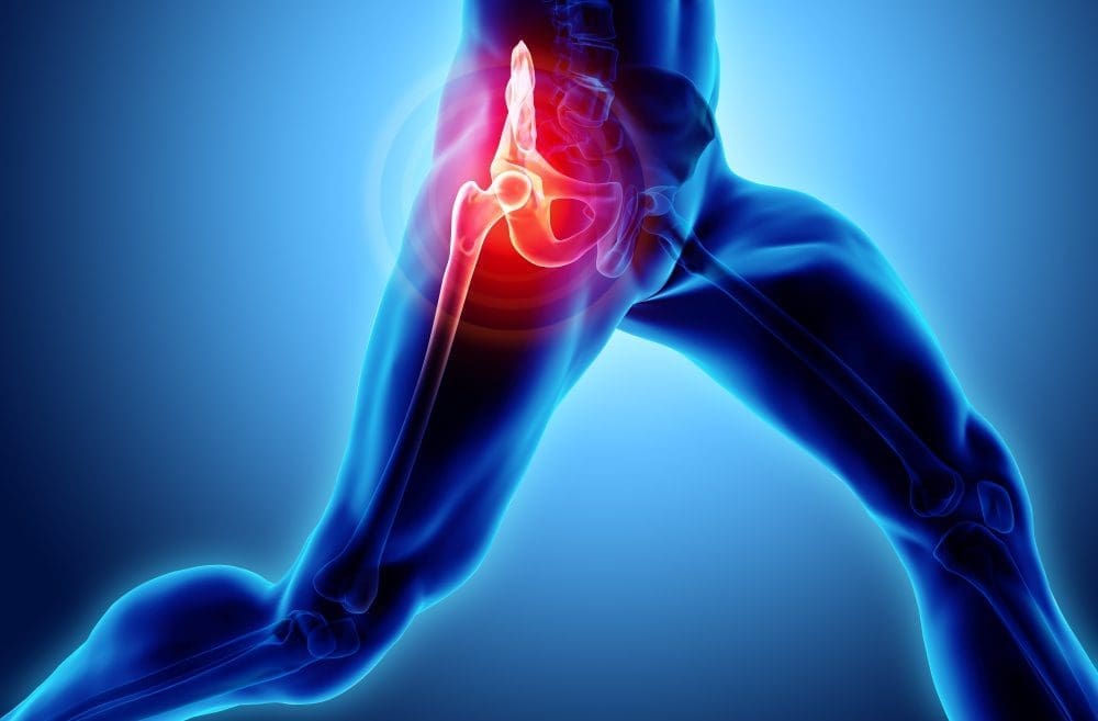 The Impact On Osteoarthritis On The Hips