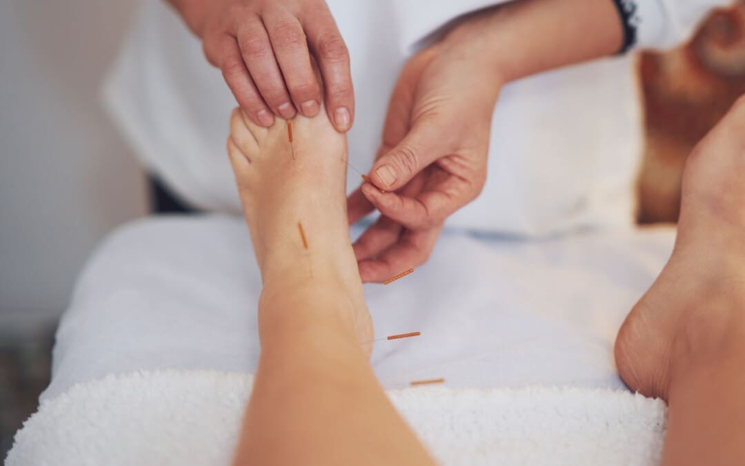 Restore Your Feet with Acupuncture Plantar Fasciitis Therapy