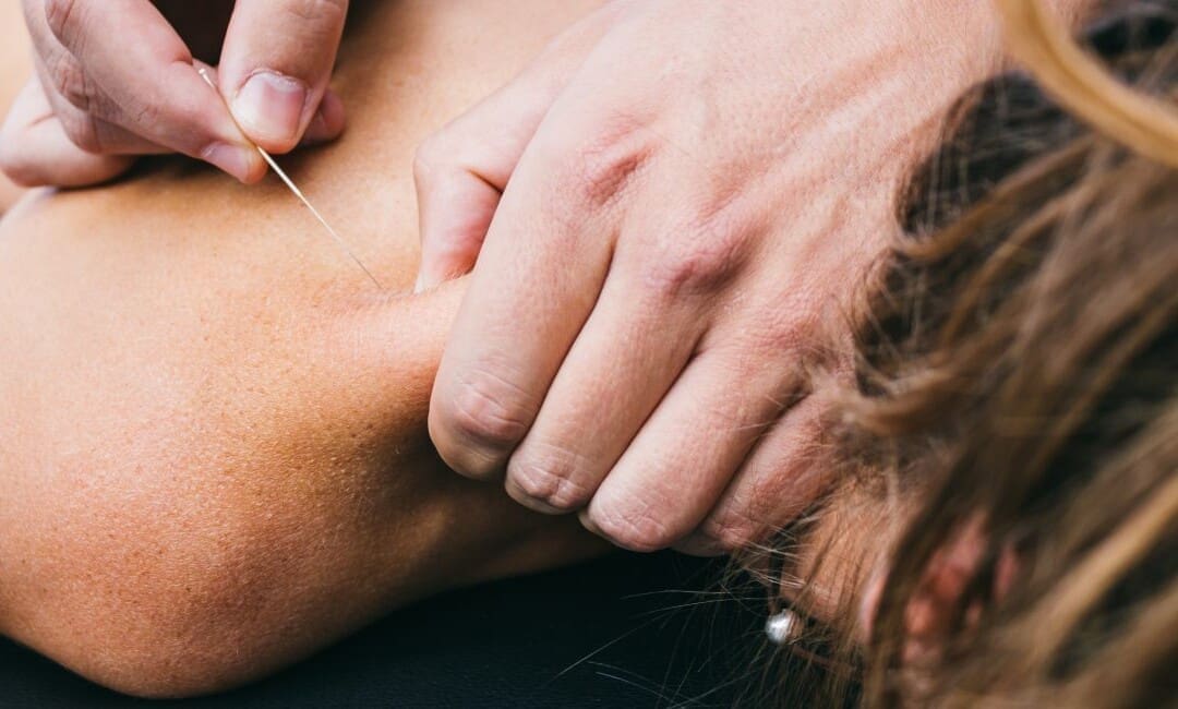 Treating Acupuncture Myofascial Pain Syndrome Effectively