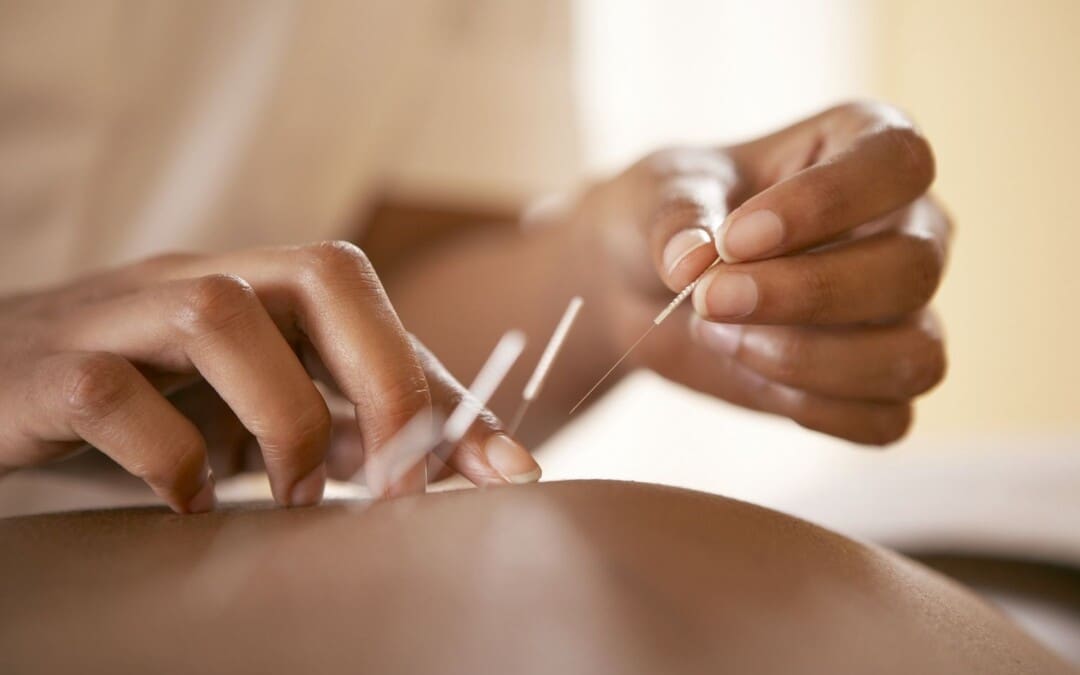 The Role of Acupuncture in Treating Muscle Pain