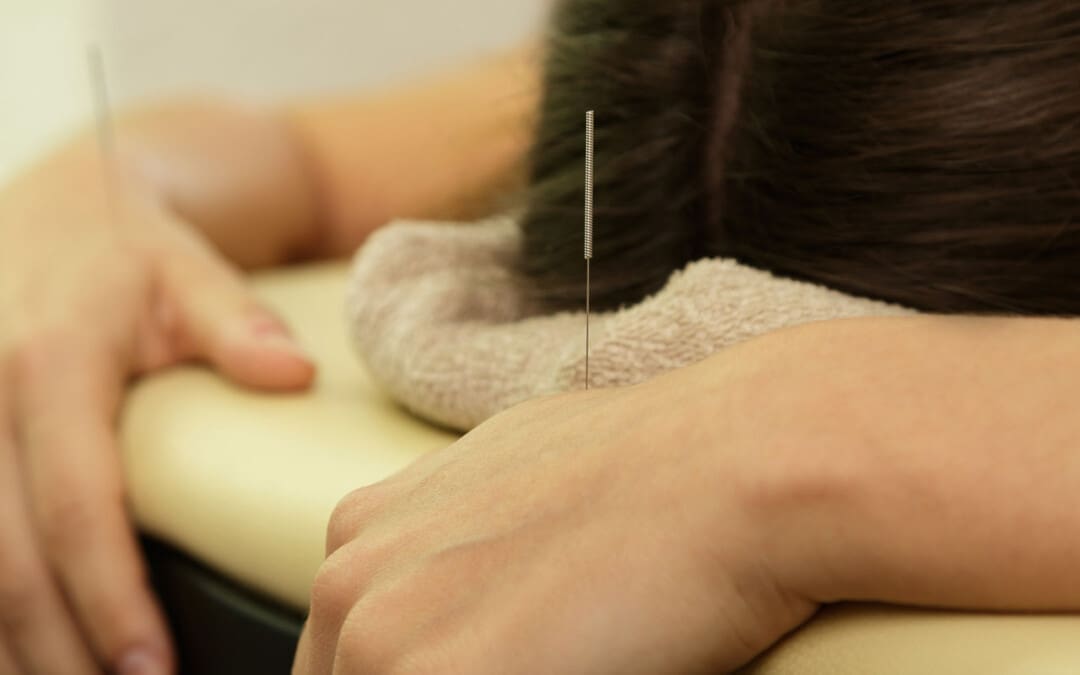 Acupuncture for Eczema: A Promising Therapy Option