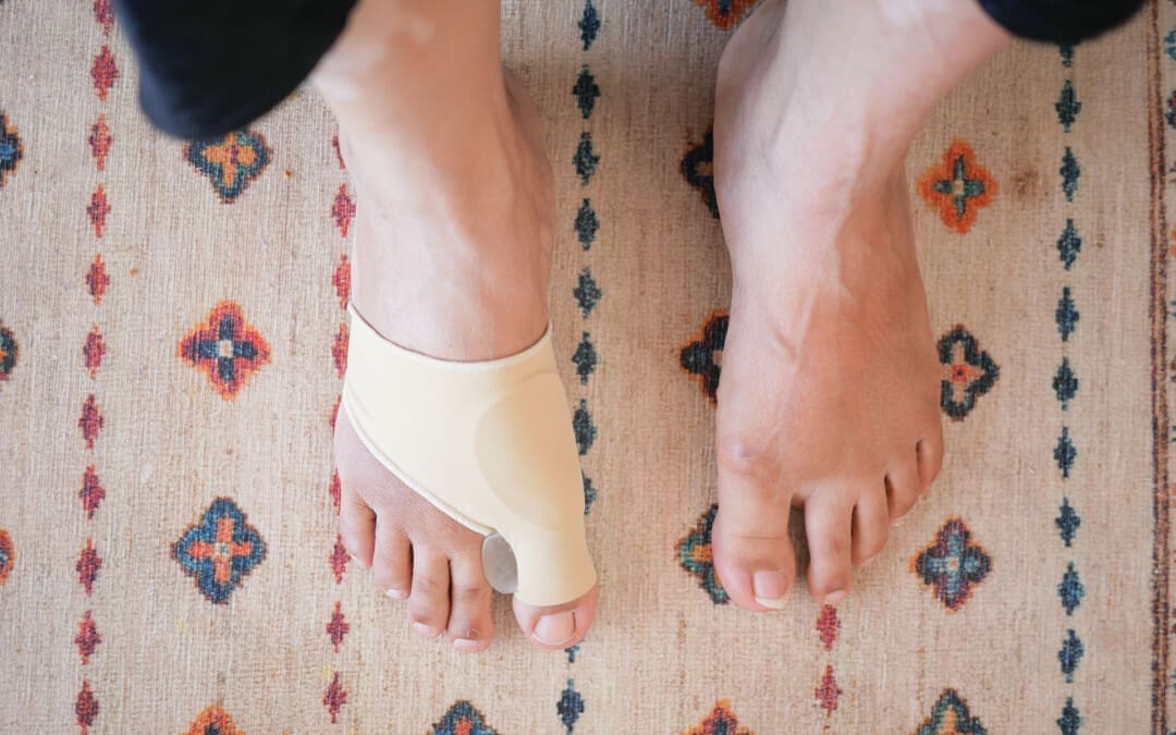 Bunions: Causes, Symptoms, and Treatments Explored